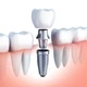Implantes Dentales