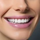 Blanqueamiento Dental