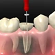 Endodoncia